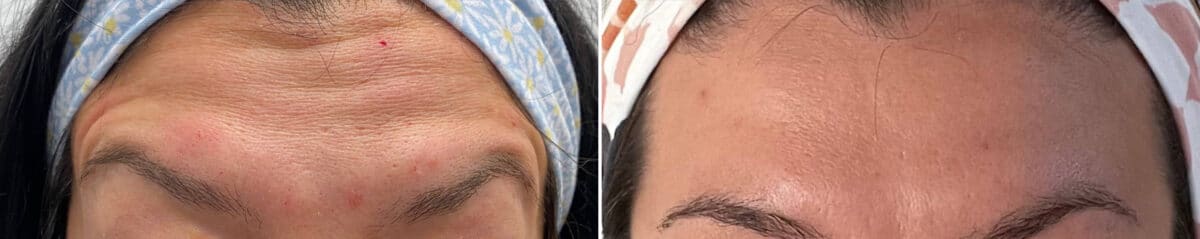 Botox Before and After Photos in Philadelphia, PA, Patient 2879