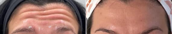 Botox Before and After Photos in Philadelphia, PA, Patient 2879