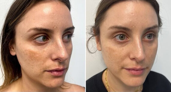 IPL Before and After Photos in Philadelphia, PA, Patient 2888