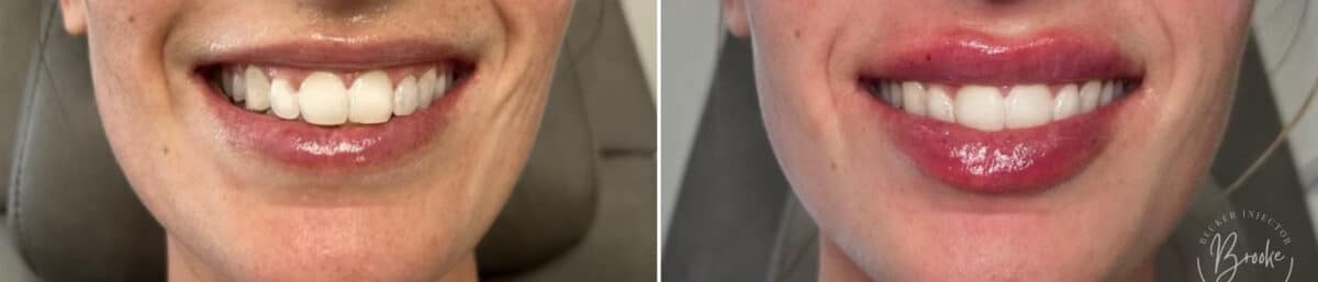 Lip Augmentation Before and After Photos in Philadelphia, PA, Patient 2897