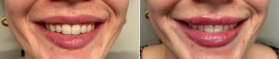 Lip Augmentation Before and After Photos in Philadelphia, PA, Patient 2909