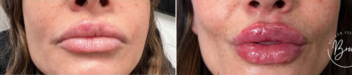 Lip Augmentation Before and After Photos in Philadelphia, PA, Patient 2917