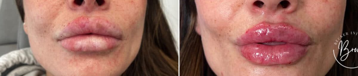 Lip Augmentation Before and After Photos in Philadelphia, PA, Patient 2917