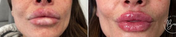 Lip Augmentation Before and After Photos in Philadelphia, PA, Patient 2917