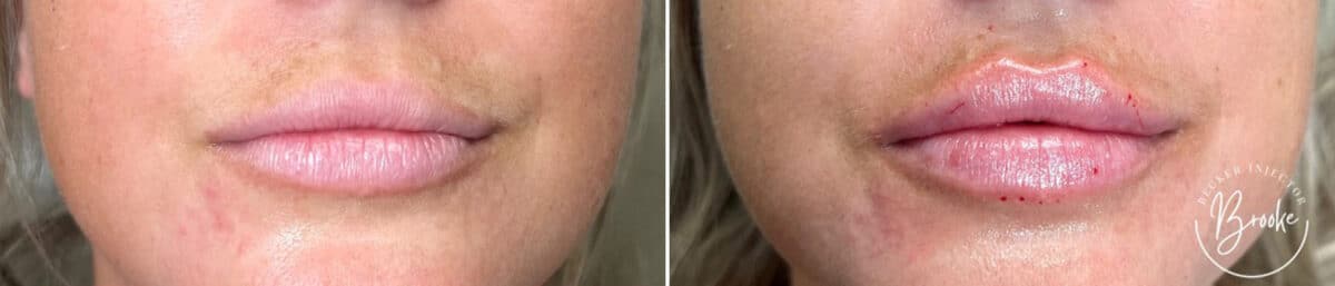 Lip Augmentation Before and After Photos in Philadelphia, PA, Patient 2930