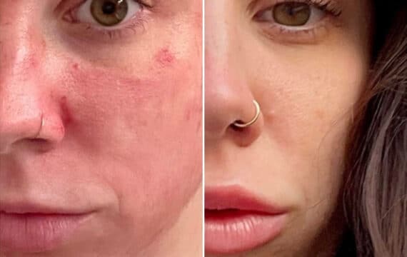 Microneedling Before and After Photos in Philadelphia, PA, Patient 2940