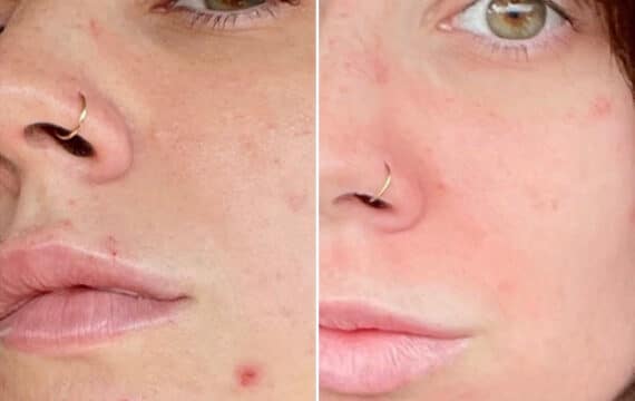 Microneedling Before and After Photos in Philadelphia, PA, Patient 2940