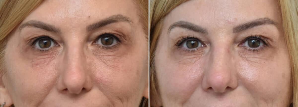 PRF Eyes Before and After Photos in Philadelphia, PA, Patient 2961