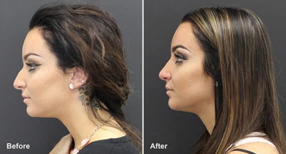 Rhinoplasty Before and After Photos in Voorhees Township, NJ, Patient 482