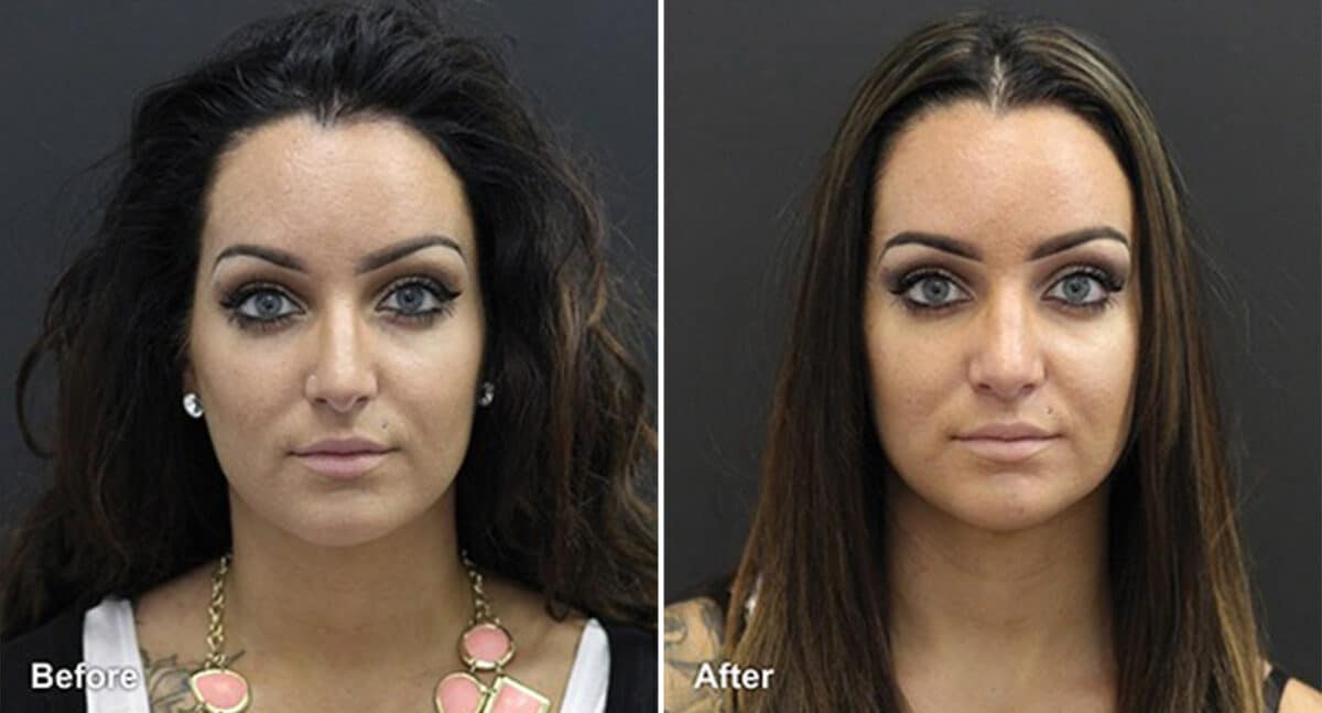 Patient 482, Rhinoplasty Before and After Photos Rhinoplasty Before and After Photos in Voorhees Township, NJ, Patient 482