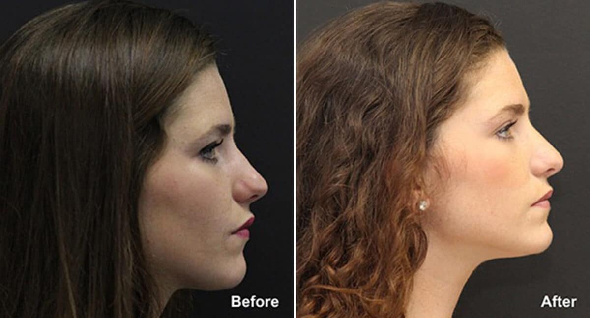 Patient 492, Rhinoplasty Before and After Photos Rhinoplasty Before and After Photos in Voorhees Township, NJ, Patient 492