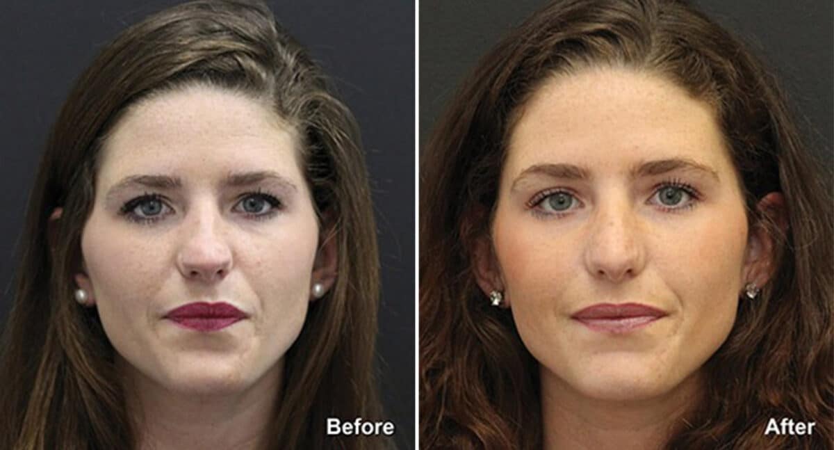 Patient 492, Rhinoplasty Before and After Photos Rhinoplasty Before and After Photos in Voorhees Township, NJ, Patient 492