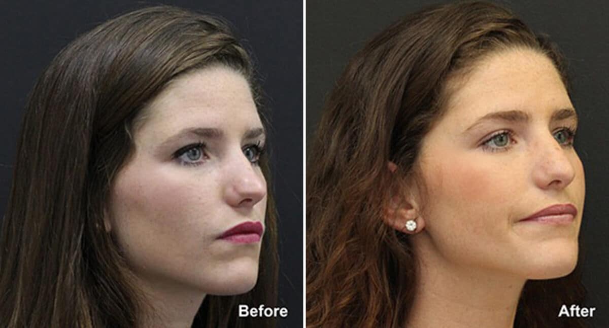 Patient 492, Rhinoplasty Before and After Photos Rhinoplasty Before and After Photos in Voorhees Township, NJ, Patient 492