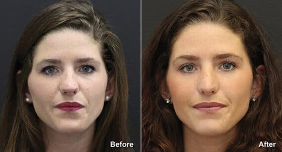 Rhinoplasty Before and After Photos in Voorhees Township, NJ, Patient 492