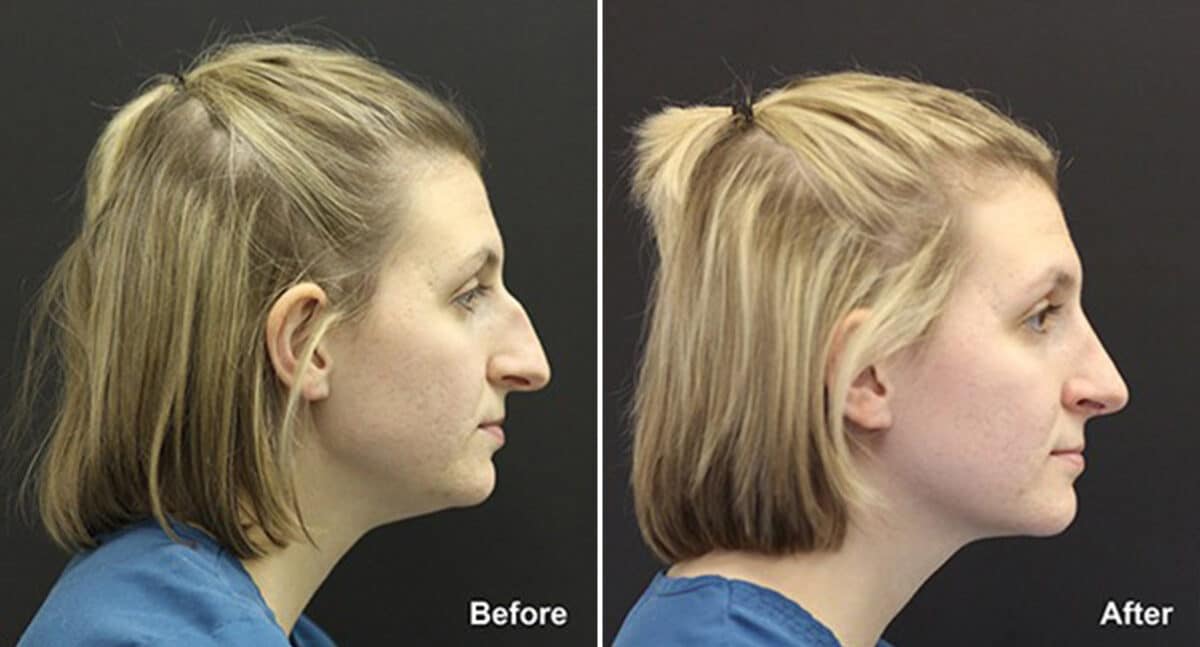 Patient 502, Rhinoplasty Before and After Photos Rhinoplasty Before and After Photos in Voorhees Township, NJ, Patient 502