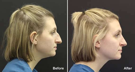 Rhinoplasty Before and After Photos in Voorhees Township, NJ, Patient 502