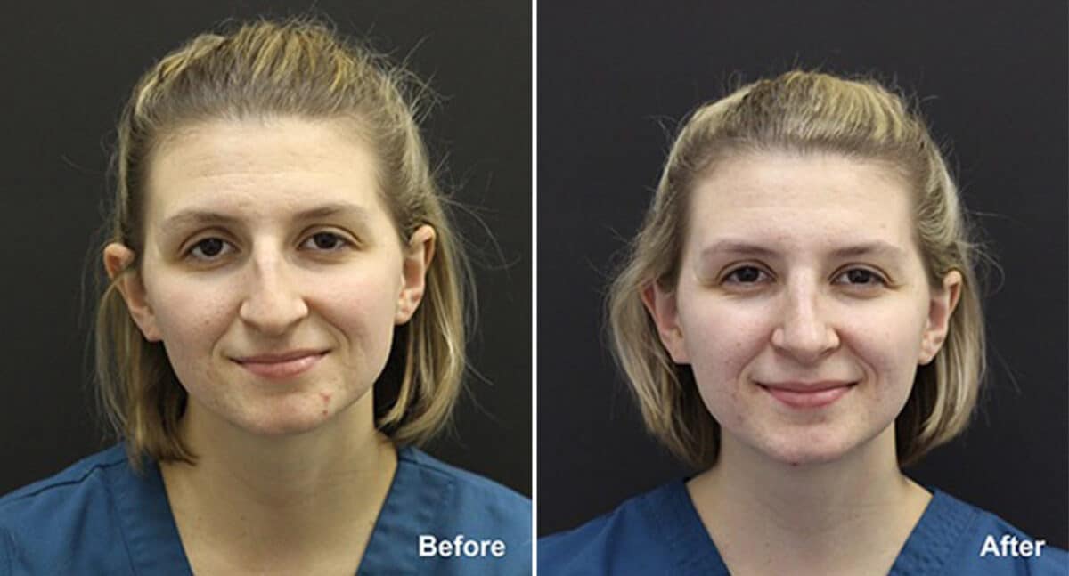 Patient 502, Rhinoplasty Before and After Photos Rhinoplasty Before and After Photos in Voorhees Township, NJ, Patient 502