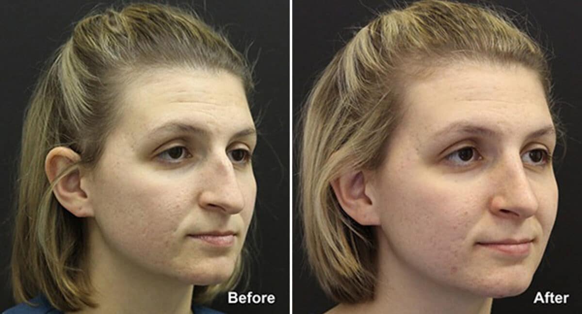 Patient 502, Rhinoplasty Before and After Photos Rhinoplasty Before and After Photos in Voorhees Township, NJ, Patient 502