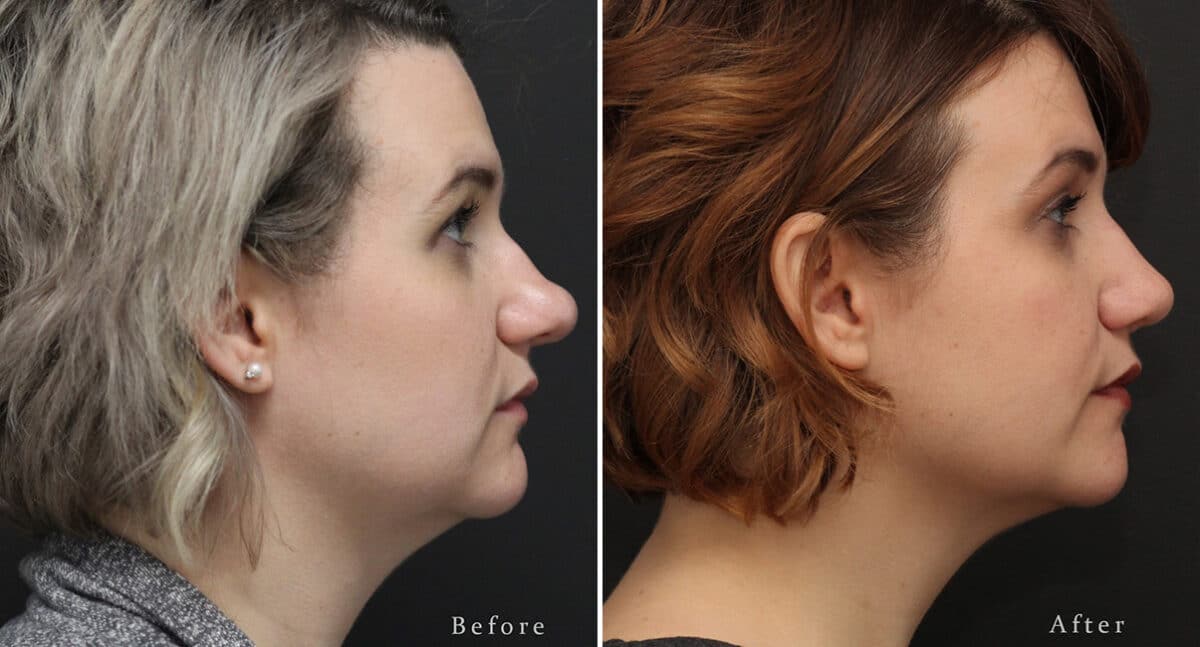 Rhinoplasty Before and After Photos in Voorhees Township, NJ, Patient 512