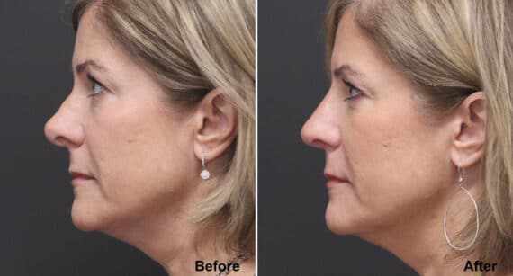 Rhinoplasty Before and After Photos in Voorhees Township, NJ, Patient 519