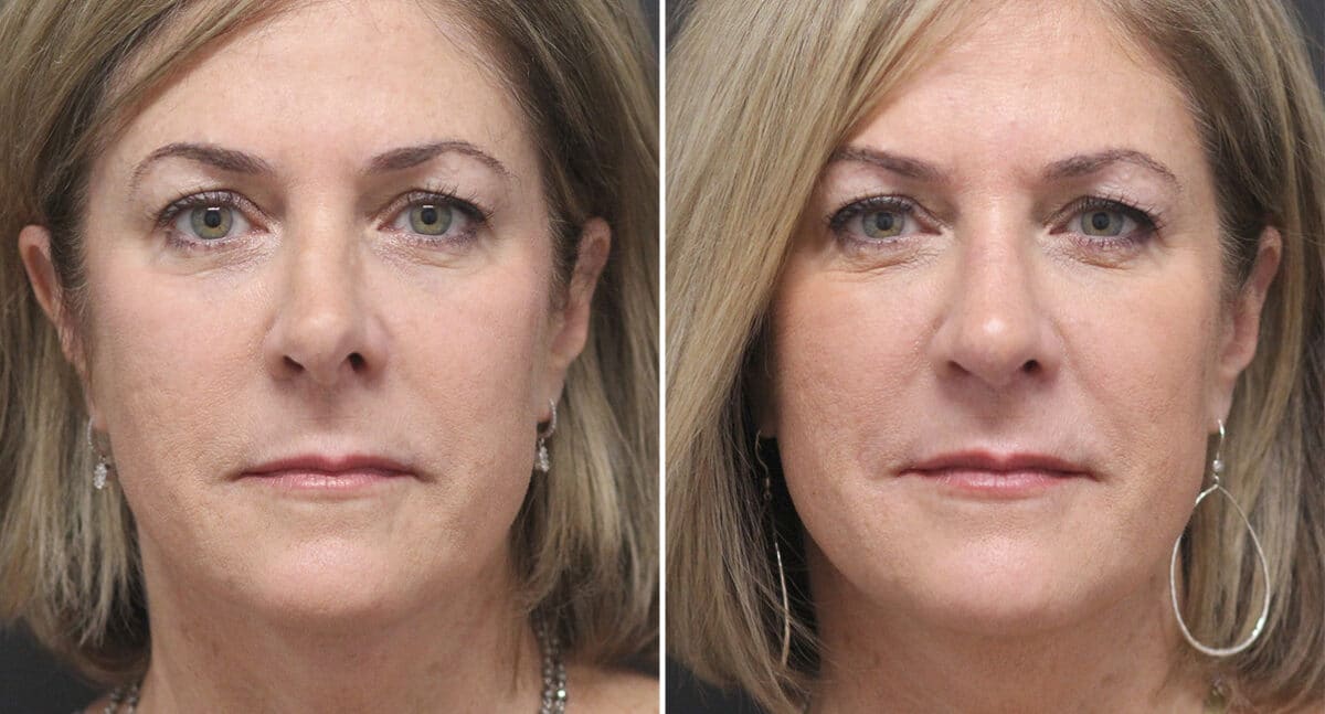 Rhinoplasty Before and After Photos in Voorhees Township, NJ, Patient 519