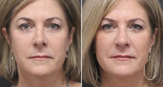 Rhinoplasty Before and After Photos in Voorhees Township, NJ, Patient 519