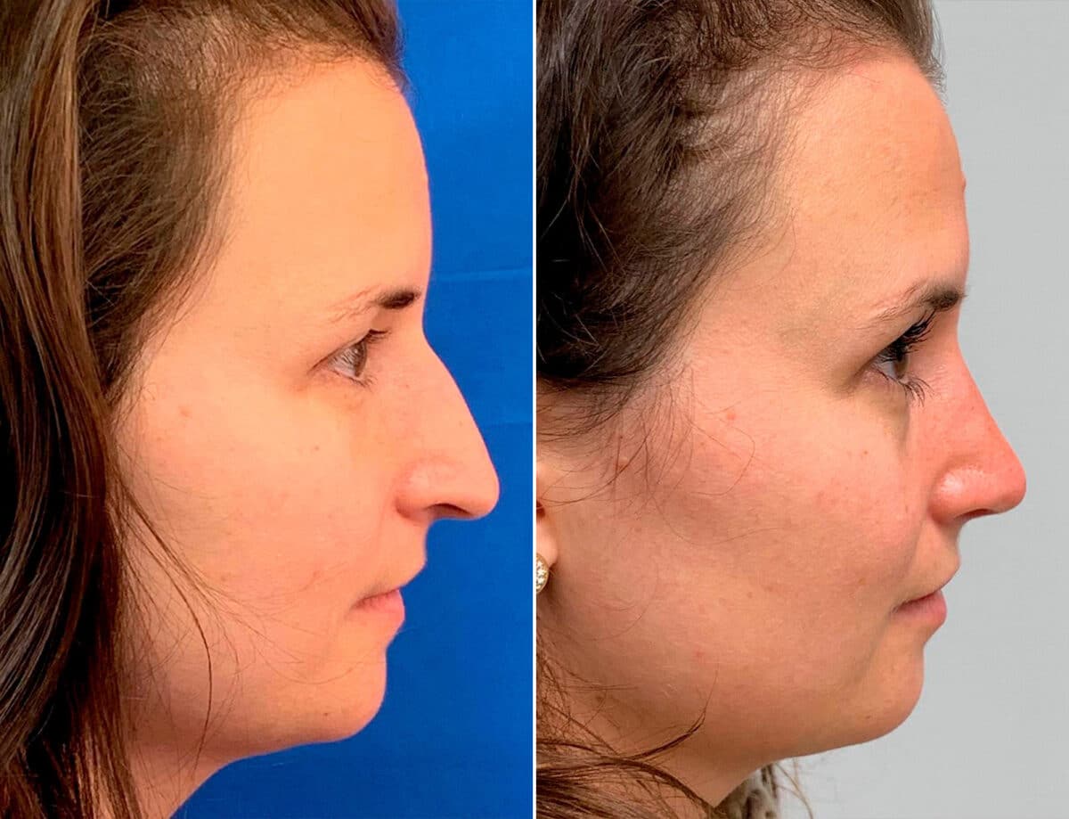 Droopy Nose Before and After Photos in Sewell, NJ, Patient 1750