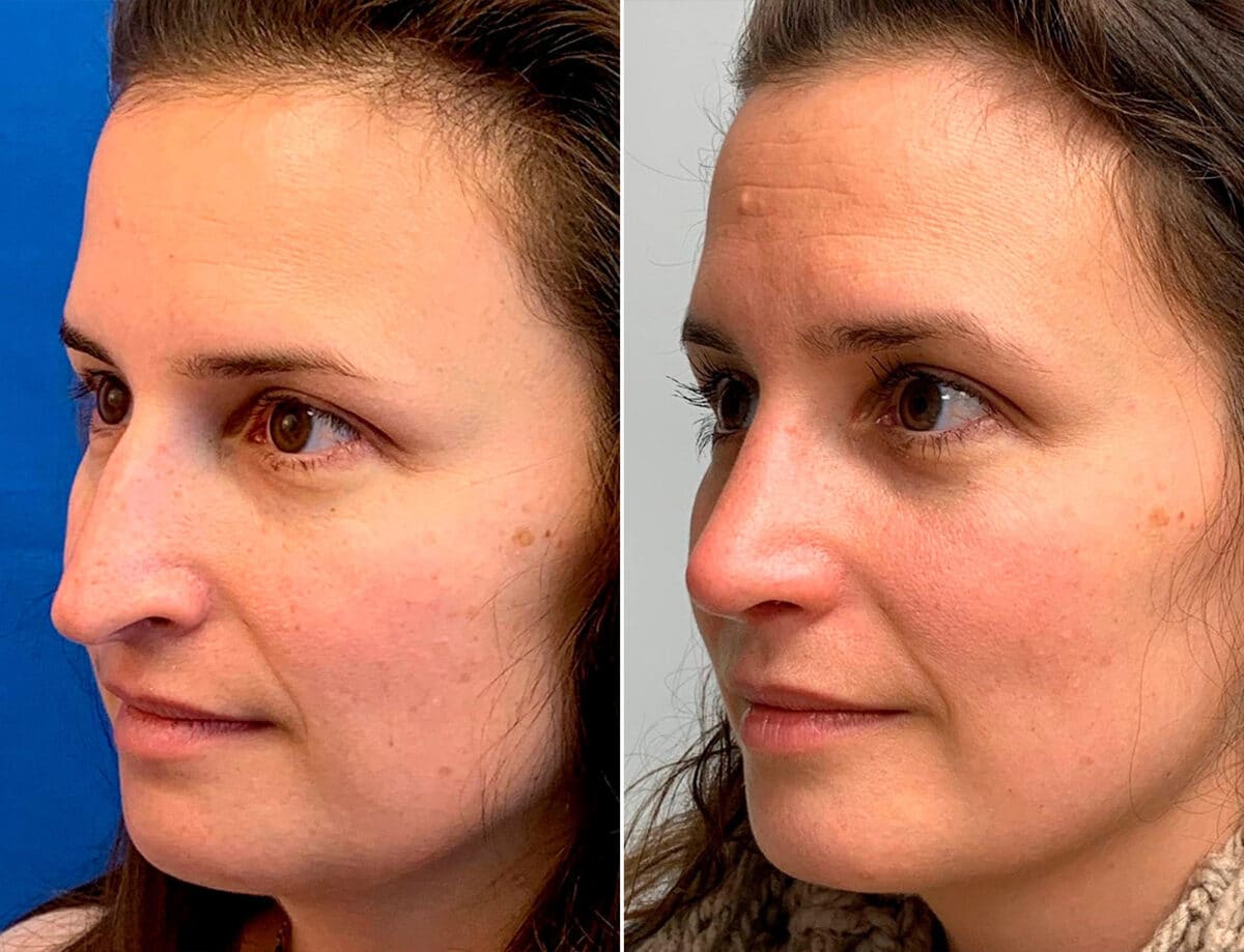 Droopy Nose Before and After Photos in Sewell, NJ, Patient 1750