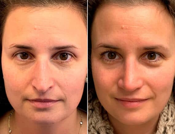 Droopy Nose Before and After Photos in Sewell, NJ, Patient 1750