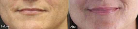 Lip Augmentation Before and After Photos in Philadelphia, PA, Patient 1144