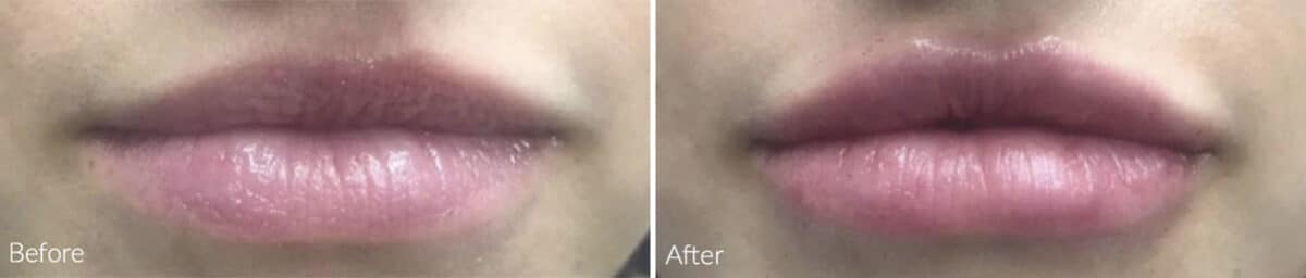 Lip Augmentation Before and After Photos in Philadelphia, PA, Patient 1160