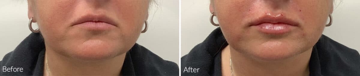 Lip Augmentation Before and After Photos in Philadelphia, PA, Patient 1164