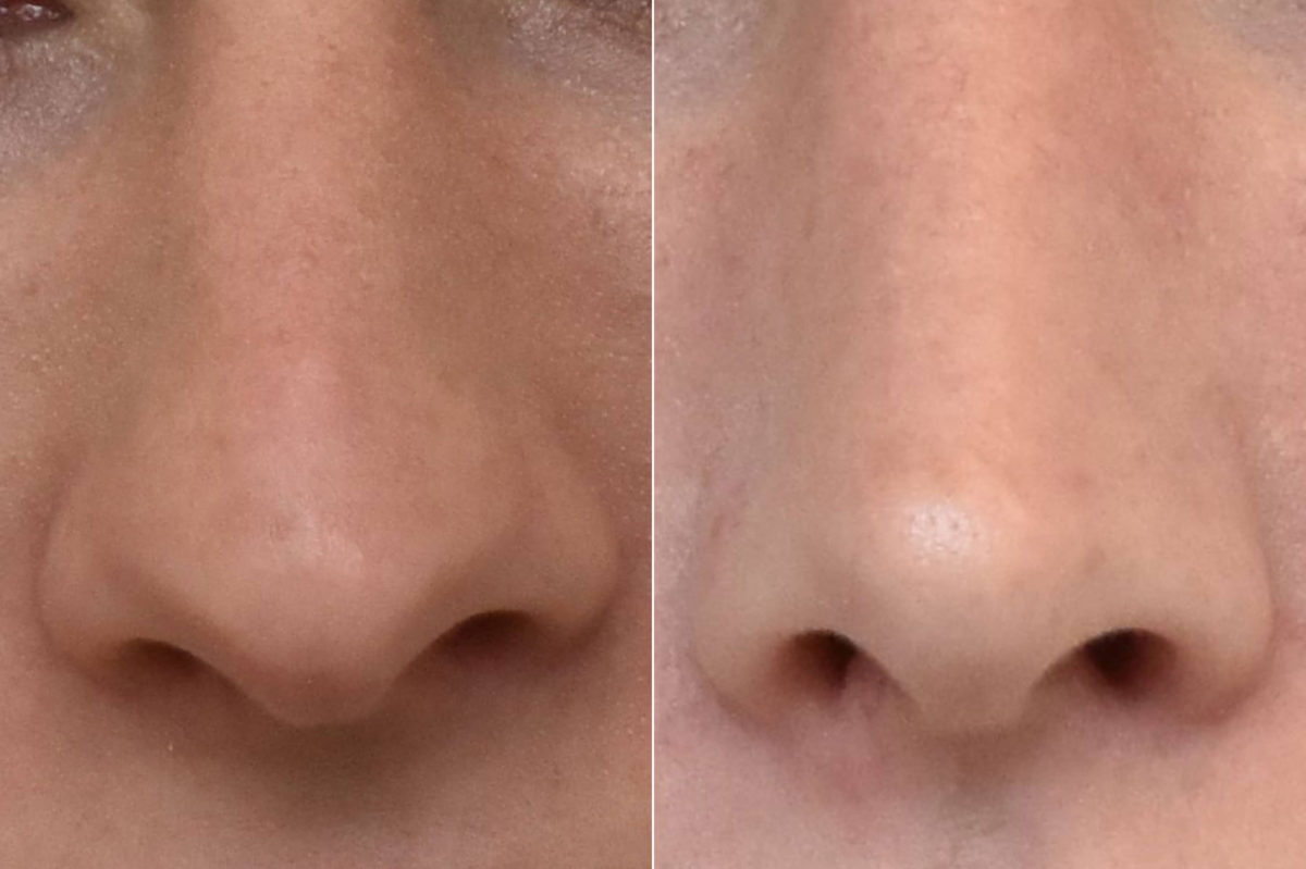 Rhinoplasty Before and After Photos in Philadelphia, PA, Patient 3161