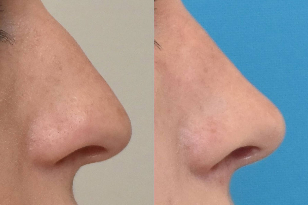 Rhinoplasty Before and After Photos in Philadelphia, PA, Patient 3161