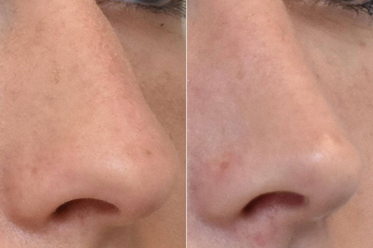 Rhinoplasty Before and After Photos in Philadelphia, PA, Patient 3161