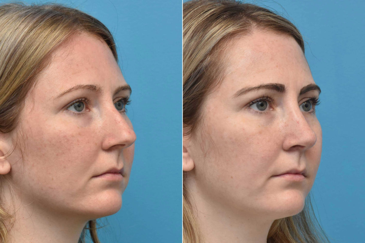 Rhinoplasty Before and After Photos in Philadelphia, PA, Patient 3211