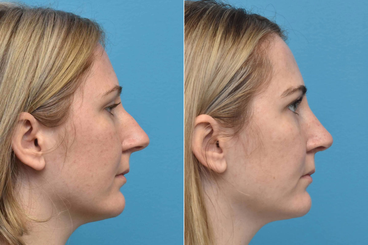 Rhinoplasty Before and After Photos in Philadelphia, PA, Patient 3211