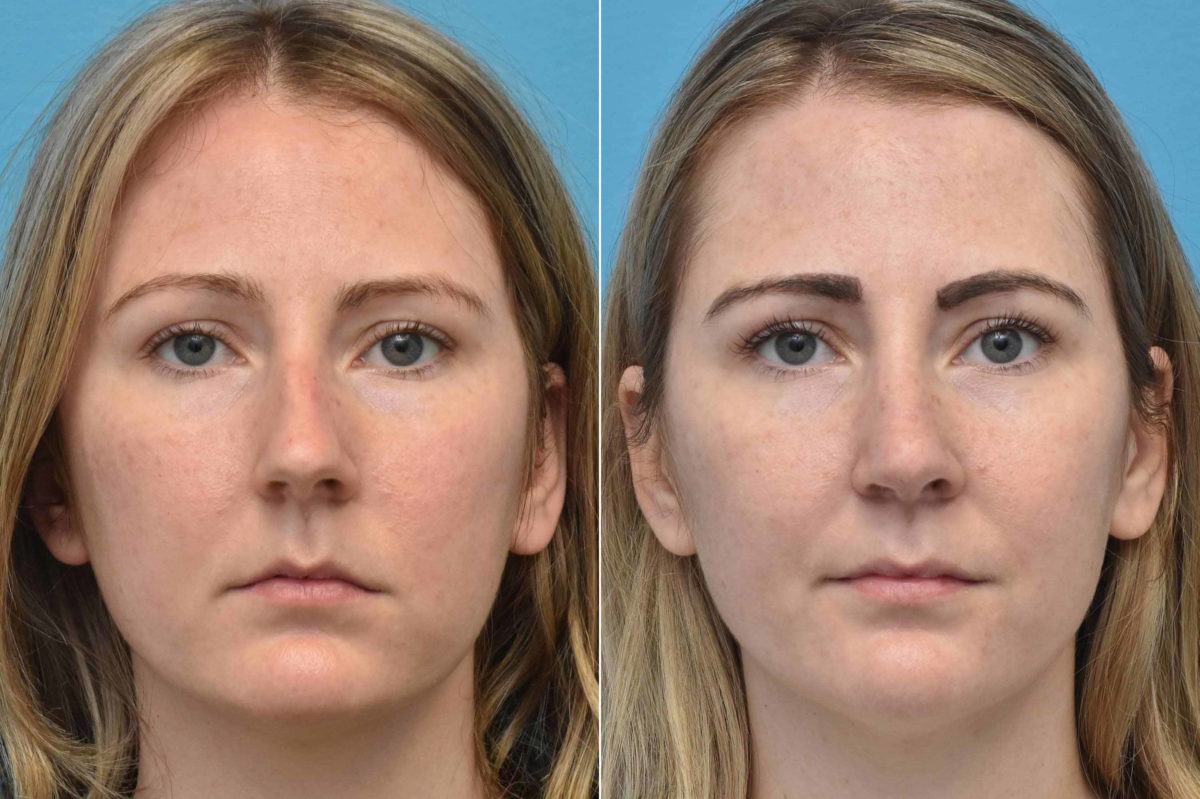 Rhinoplasty Before and After Photos in Philadelphia, PA, Patient 3211