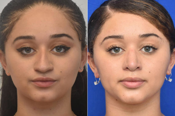 Rhinoplasty Before and After Photos in Philadelphia, PA, Patient 3215