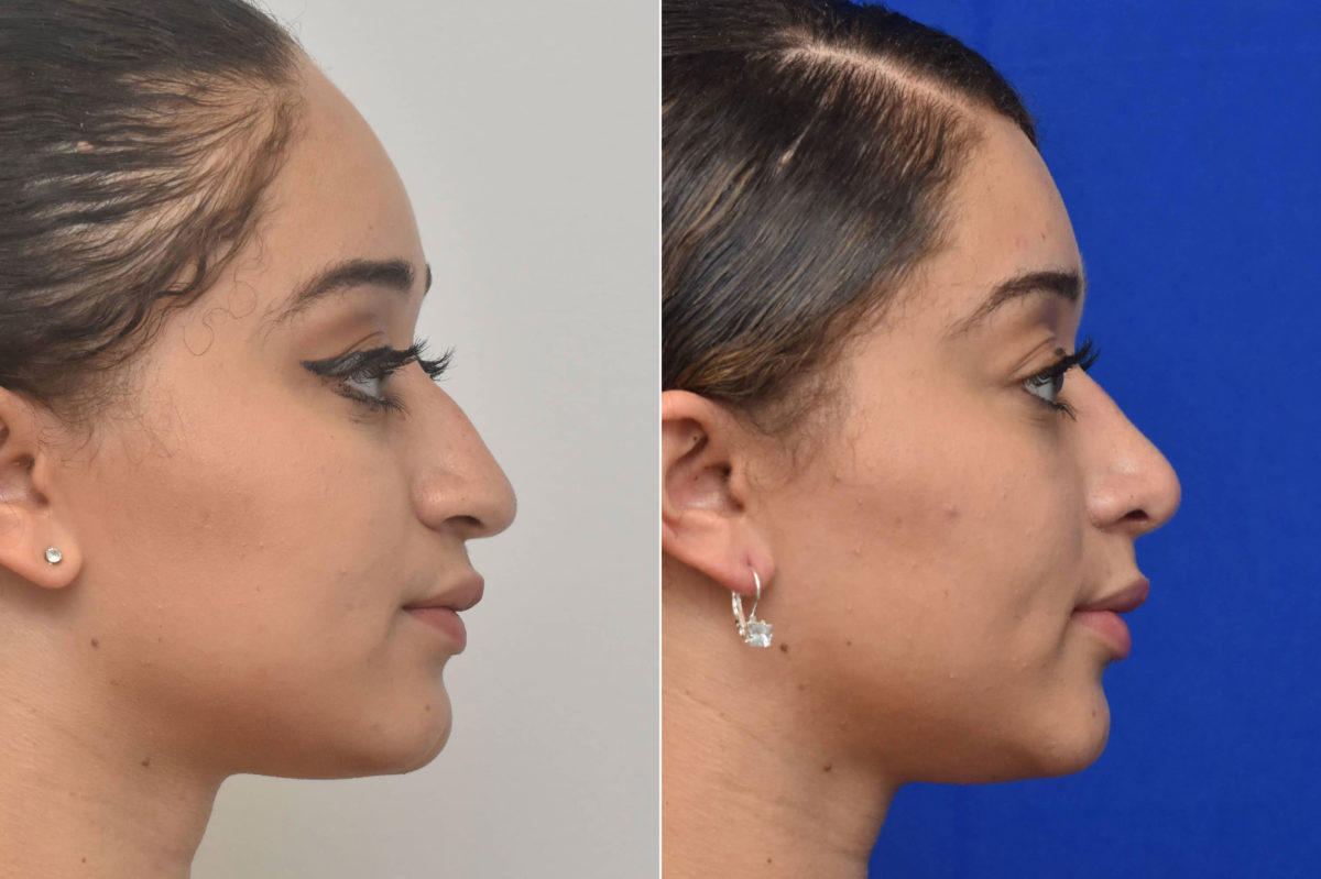 Rhinoplasty Before and After Photos in Philadelphia, PA, Patient 3215