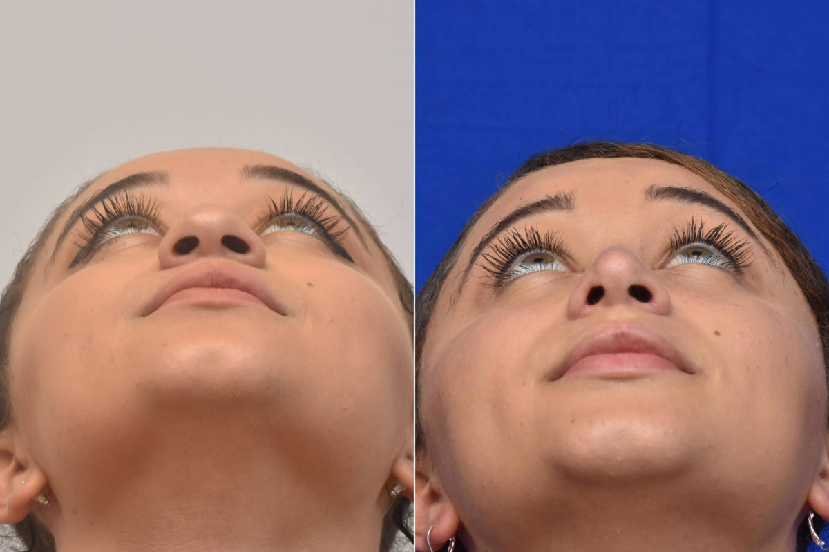 Rhinoplasty Before and After Photos in Philadelphia, PA, Patient 3215