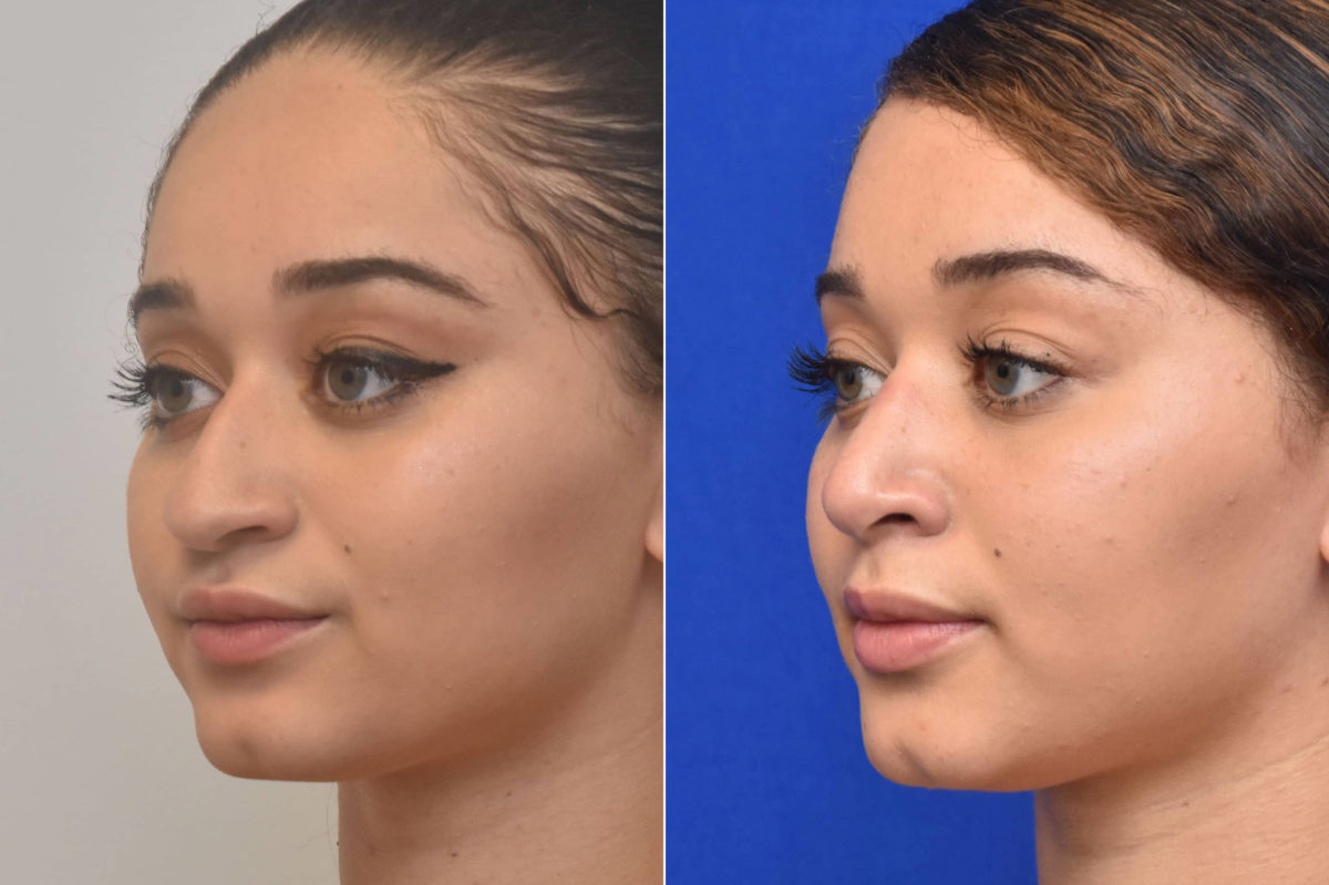 Rhinoplasty Before and After Photos in Philadelphia, PA, Patient 3215