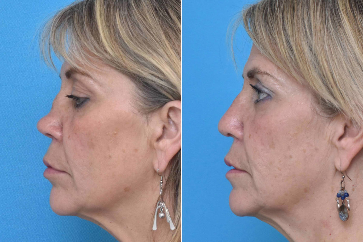 Rhinoplasty Before and After Photos in Philadelphia, PA, Patient 3220