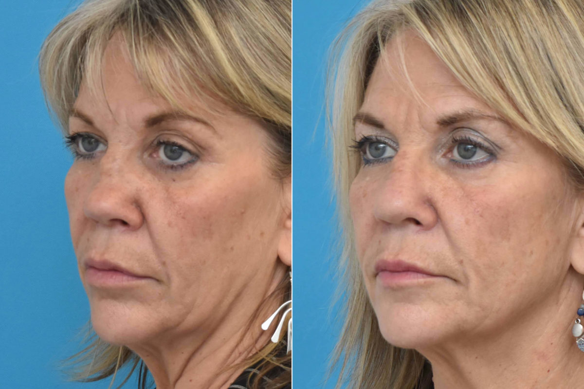 Rhinoplasty Before and After Photos in Philadelphia, PA, Patient 3220