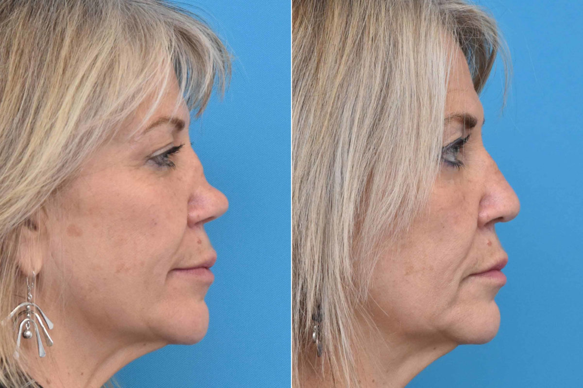 Rhinoplasty Before and After Photos in Philadelphia, PA, Patient 3220