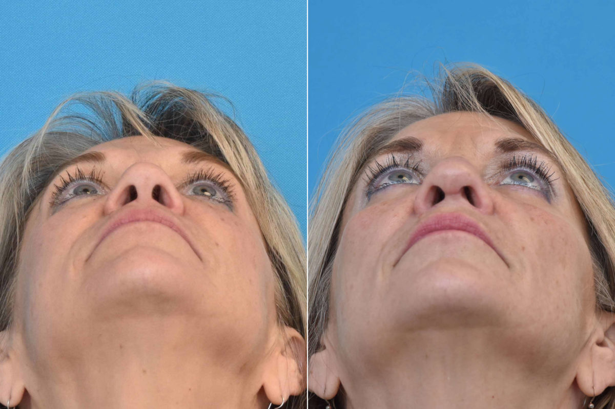 Rhinoplasty Before and After Photos in Philadelphia, PA, Patient 3220