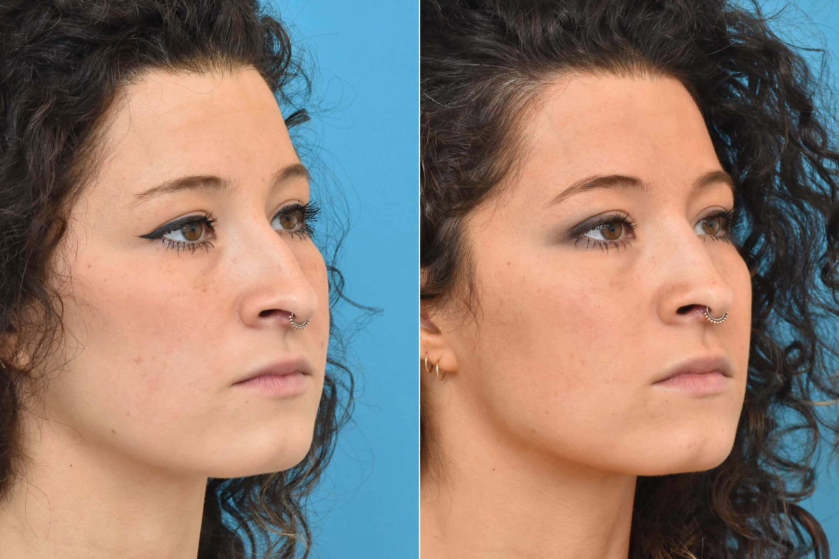 Rhinoplasty Before and After Photos in Philadelphia, PA, Patient 3226