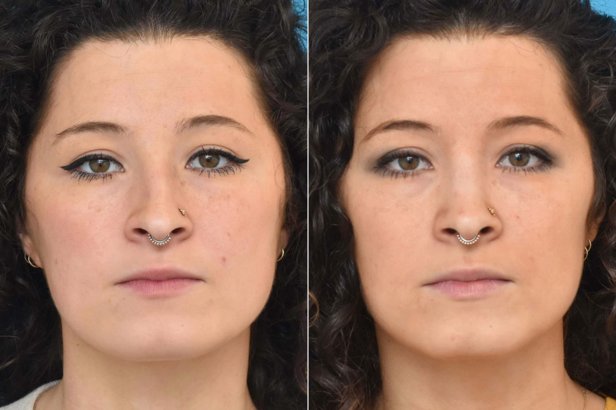 Rhinoplasty Before and After Photos in Philadelphia, PA, Patient 3226