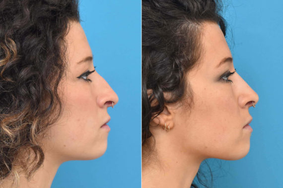 Rhinoplasty Before and After Photos in Philadelphia, PA, Patient 3226