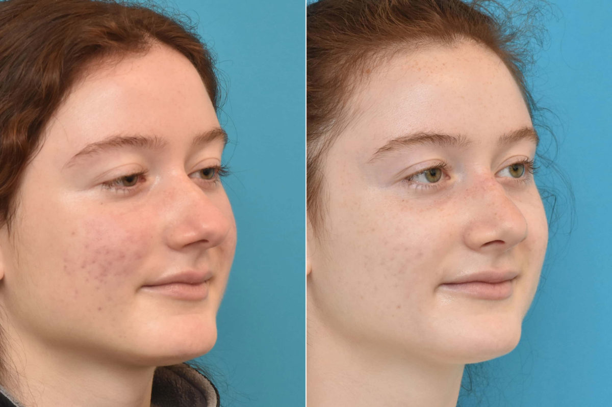 Rhinoplasty Before and After Photos in Philadelphia, PA, Patient 3230